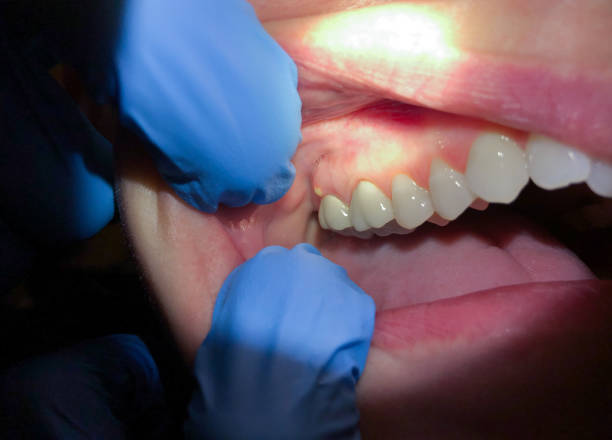 Best Root Canal Emergency Dentist  in Willacoochee, GA